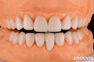 Quality Ceramic Emax Veneers 0.3-0.5mm Thickness Long Lasting Cosmetic Porcelain Veneers wholesale