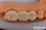 High Strength Dental Zirconia Your Ultimate Solution For Natural-looking