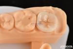 0.5mm-2mm Precise Fit Emax Dental Inlay Onlay For Reliable Tooth Restoration