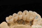 Experience Ultimate Esthetics With Aesthetically Pleasing Dental Implant Crown