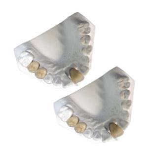 Quality Good Mechanical Porcelain Metal Crowns Yellow Gold High Strength wholesale