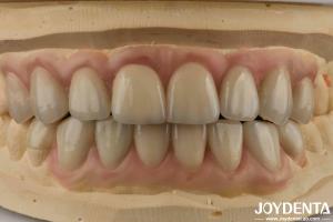 Quality High Translucency Emax Cosmetic Dentistry Veneers High Aesthetics Ultra Thin wholesale