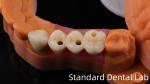 Professional Zirconia Dental Implant Crown Titanium CAD CAM Zirconia Crown China