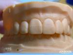 Lightweight and Smooth Dental Veneers Stain Resistance Long-lasting Durability