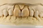 0.2mm Thickness Microthin Veneers Glass Ceramic Dental Veneers For Front Teeth