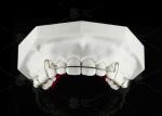 Comfortable Stainless Steel Acrylic Hawley Retainer Effective Orthodontic