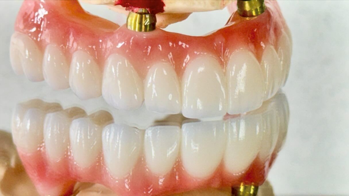 Dental All On X Implant PFM Crown Titanium Fixed Hybrid Denture