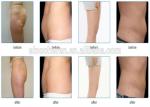 Portable Cavitation Body Slimming Machine Fat Melting Ultrasonic Cavitation
