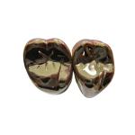 High Strength FMC Metal Crown Tooth Semi Precious Metal Crown