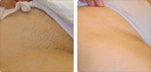 Quality high performance diode laser hair removal price wholesale