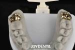 Oral Rehabilitation With Dental Achieve Brighter And Healthier Smile