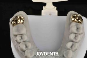 Quality Oral Rehabilitation With Dental Achieve Brighter And Healthier Smile wholesale