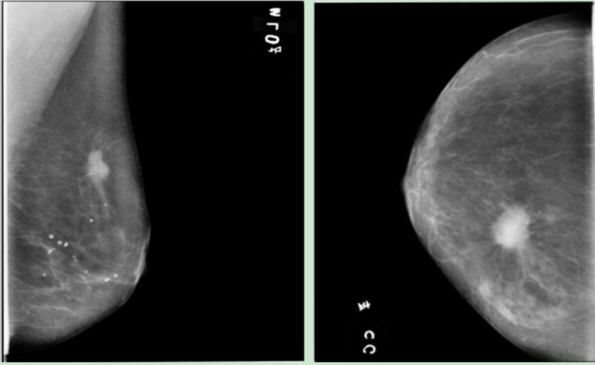 Full Digital Mammography System with Panel Detector for Sales