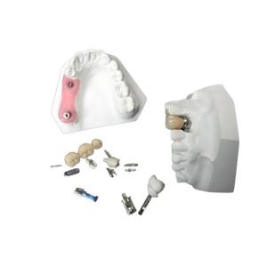 Quality High Durability Zirconia Dental Implant Crown For Dental Restoration wholesale