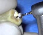 Nickel Titanium Niti Flexible Thermal Gold Files Rotary Type Heat - Activation