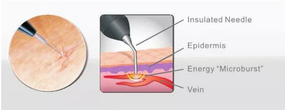 50W 980 Nm Diode Laser Spider Vein Removal Machine For Blood Vessel Treatment Solution