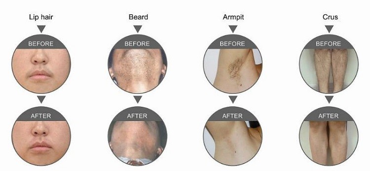 Newest System Professional Diode Laser Hair Removal Machine Stationary Style