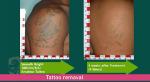 Commercial Q Switched Laser Tattoo Removal Machine 1064nm 532nm 755nm