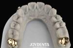 Oral Rehabilitation With Dental Achieve Brighter And Healthier Smile