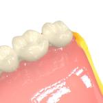 Denture Bases Biocompatible 3d Resin Pink Dental 3d Printing Resin