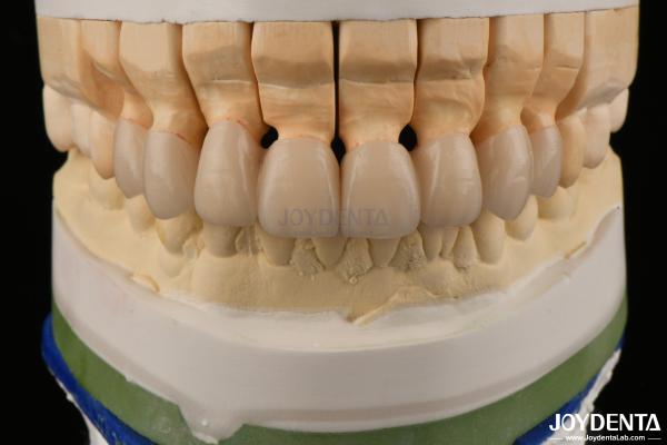 High Translucency Layered Zirconia Crowns Bridges Dental Restorations lifelike