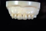 Zirconia All-Ceramic Teeth Crowns & Bridges
