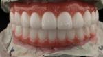 High Quality Dental zirconia crown and All On Four Six Implant Full Arch / China