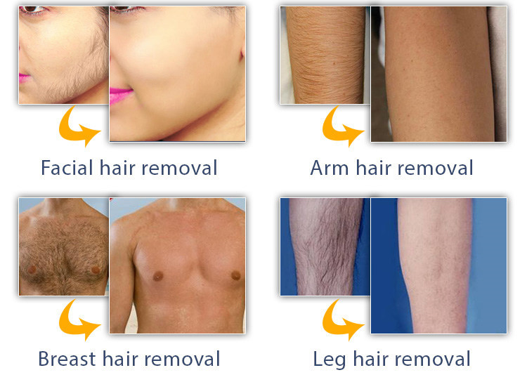 2400W 590nm 430nm Laser Hair Removal Machine For Clinic