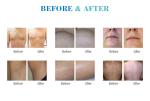 Germany DILAS laser bars permanent salon laser hair removal machine for dark