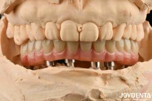 Quality Aesthetic Titanium Malong Hybrid Dental Implant Bridge For Dental Perfection wholesale