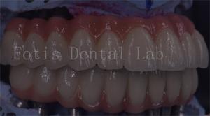 Quality OEM Service Durable Dental Implant Temporary Crown Easy Maintenance wholesale