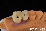 Porcelain Implant Crown and Bridge The Ultimate Solution for Restoration Of