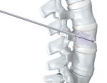 PKP Surgical Spine Kyphoplasty Instrument , Balloon Kyphoplasty Orthopedic