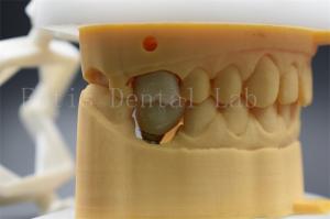 Quality Customizable Dental Implant Abutment Crown Comfortable For Patients wholesale
