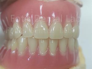 China Comfort Custom Fit Full Acrylic Denture For Precise Dental Prosthesis on sale