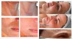 LDM Dual Frequency Skin Care Machine Ultrasound Hydra Facial Rejuvenation