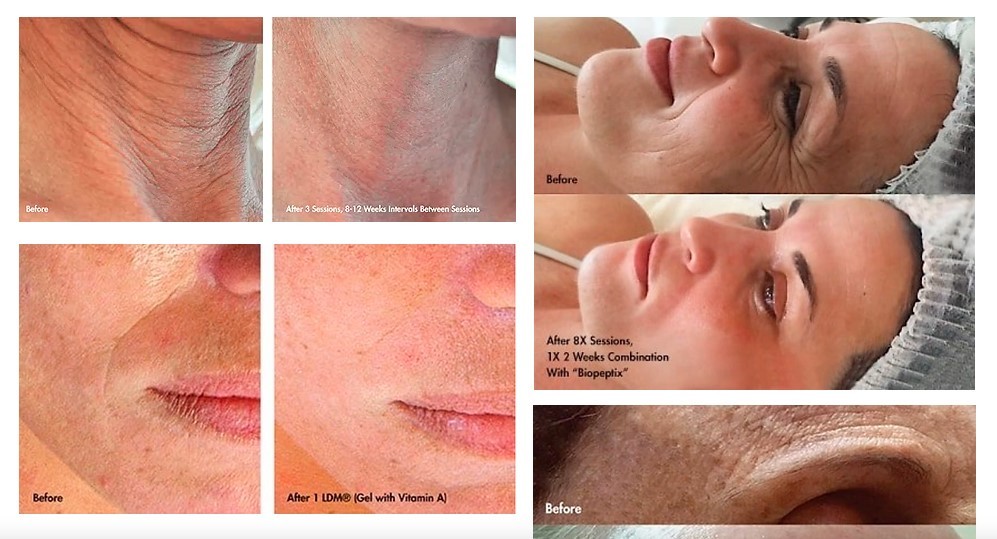 LDM Dual Frequency Skin Care Machine Ultrasound Hydra Facial Rejuvenation