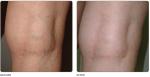 arm laser EQUIPMENT