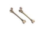 Antirotation PNFA Implanted Titanium Proximal Femoral Nail