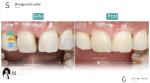 Ceramic For Natural Aesthetics Dental Veneers Stain Resistance Maintains