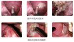 Compact Cold Urology Coblation Plasma Surgery System Minimally Invasive