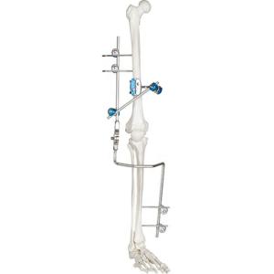 Quality Medical Knee Joint External Fixation Device Orthopedic Surgical Instruments wholesale