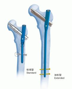 Quality Orthopedics Titanium Gamma Interlocking Nail Ⅳ PFN wholesale