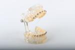 Dental Passive Self Ligating Brackets In Orthodontics