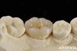 Adhesive Cementation Zirconia Dental Inlays And Onlays Natural Looking