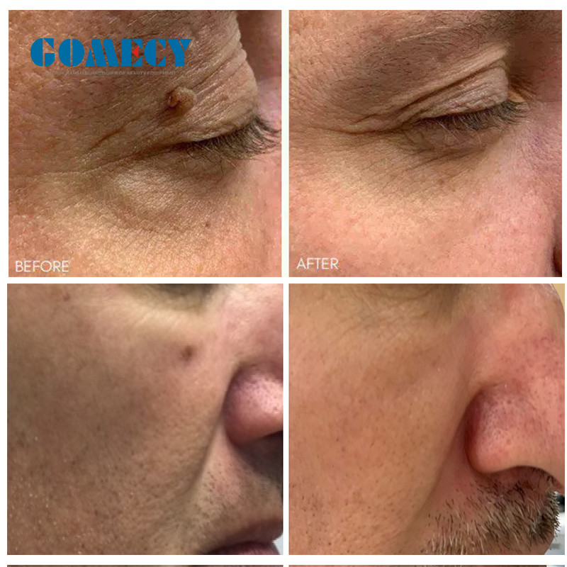 Vaginal Rejuvenation CO2 Fractional Laser System With Scanning Speed More Than 10m/S