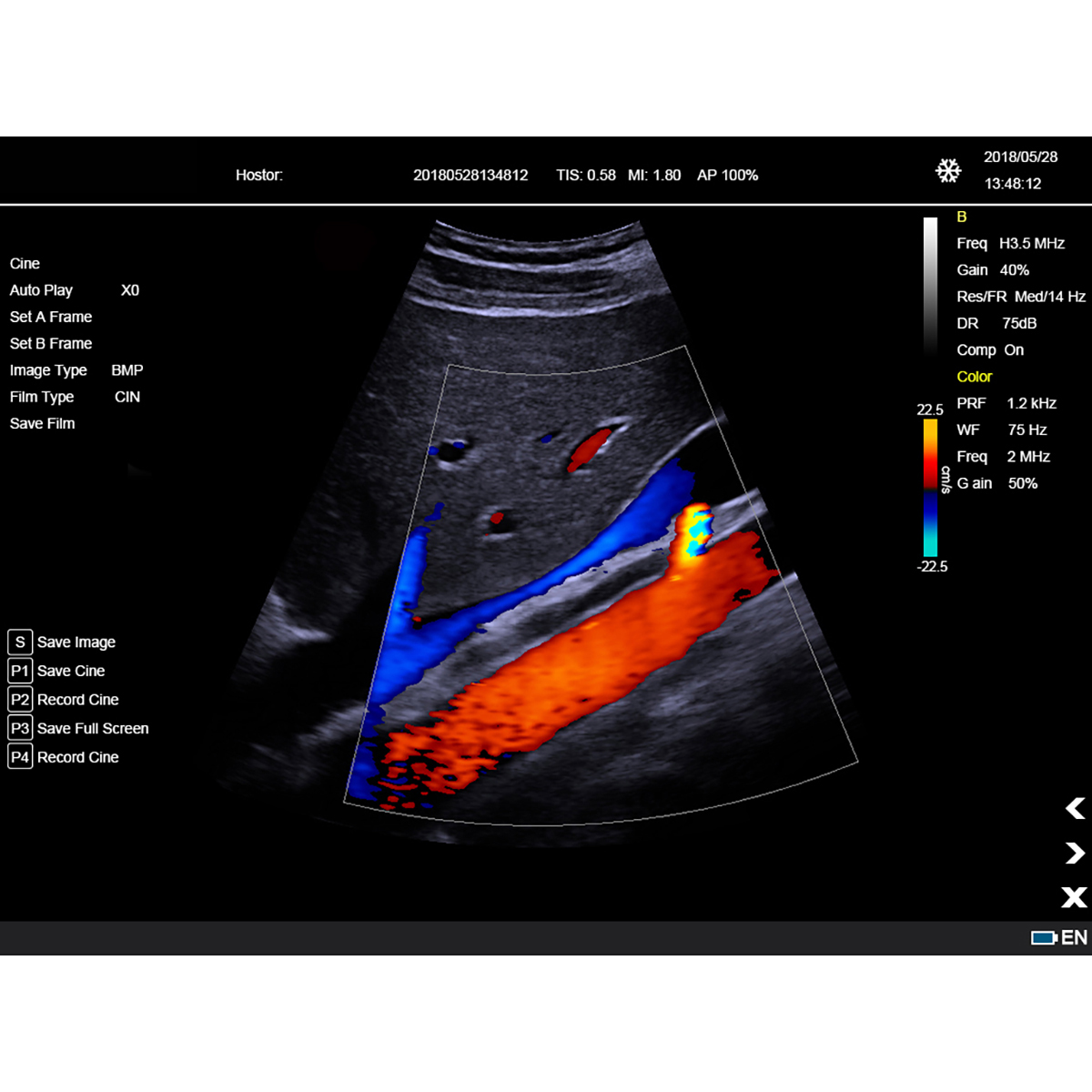 Color Doppler Portable Ultrasound Machine Medical USG PW CW DICOM Cardiac Probe Cardiology for Hospital Clinic