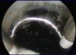 Radio Frequency Plasma Surgical Electrodes For BPH And Other Urology Diseases