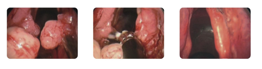 RF Plasma Surgical Coblator for Tonsillectomy and Adenoidectomy