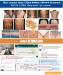 diode hair removal 3 Wavelength Diode Laser Hair Removal System 755nm 808nm